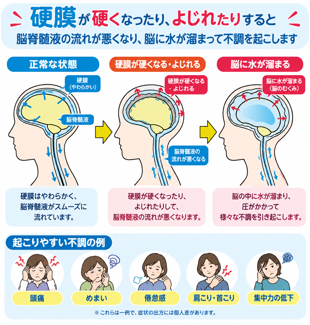 硬膜が硬くなったり、よじれたりすると脳脊髄液の流れが悪くなり、脳に水が溜まって不調を起こします。硬膜はやわらかく、脳脊髄液がスムーズに流れています。硬膜が硬くなったり、よじれたりして、脳脊髄液の流れがわるくなります。脳の中に水が溜まり、圧がかかって様々な不調を引き起こします。起こりやすい不調の例。頭痛、めまい、倦怠感、肩こり、首コリ、集中力の低下